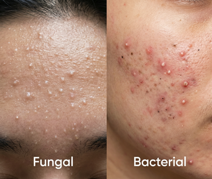 Acne Treatment Serum #1